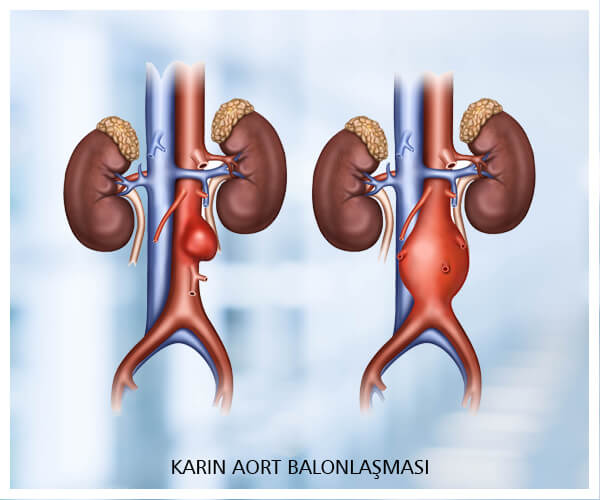 zehra-bayramoglu-karin-aort-balonlasmasi