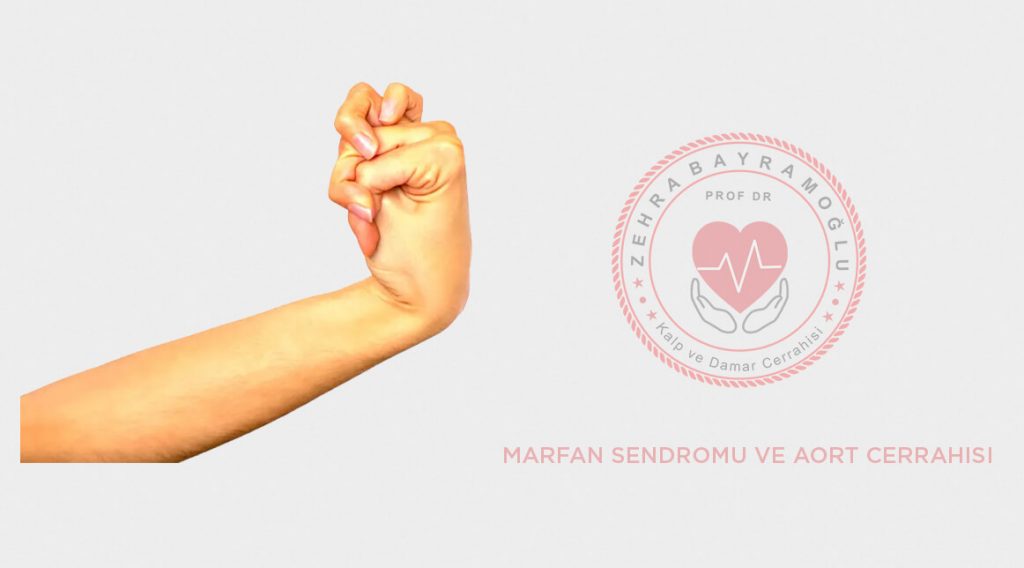 Marfan Sendromu ve Aort Cerrahisi